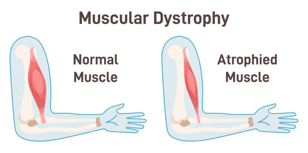 Stemcell therapy for Muscular dystrophy in india
